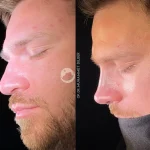 male rhinoplasty - man rhinoplasty before after