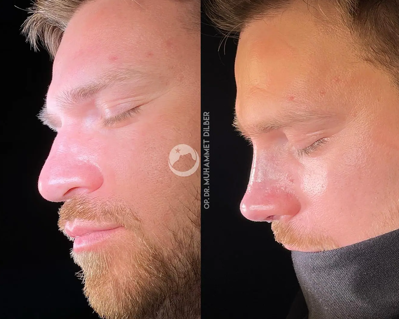 male rhinoplasty - man rhinoplasty before after
